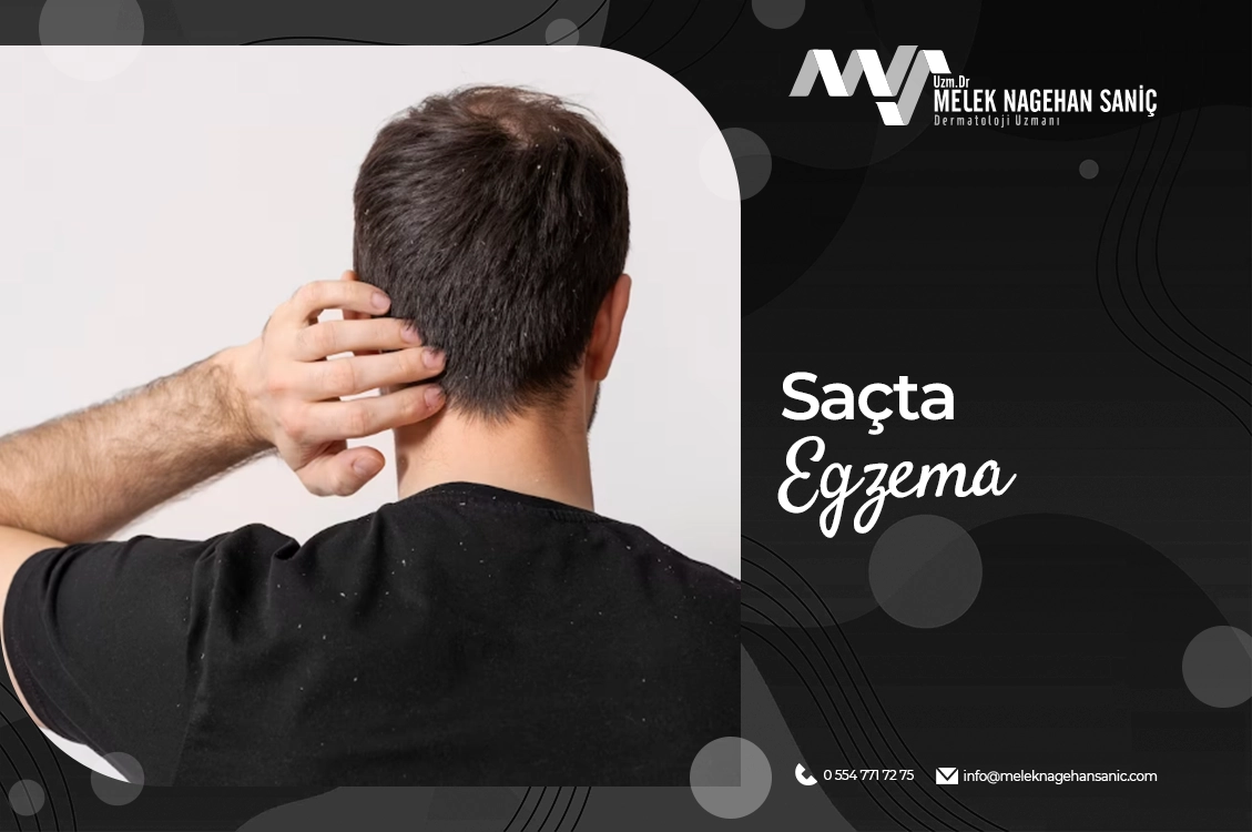 Saçta Egzama