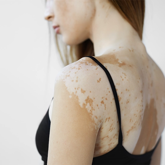 Vitiligo Nedir?
