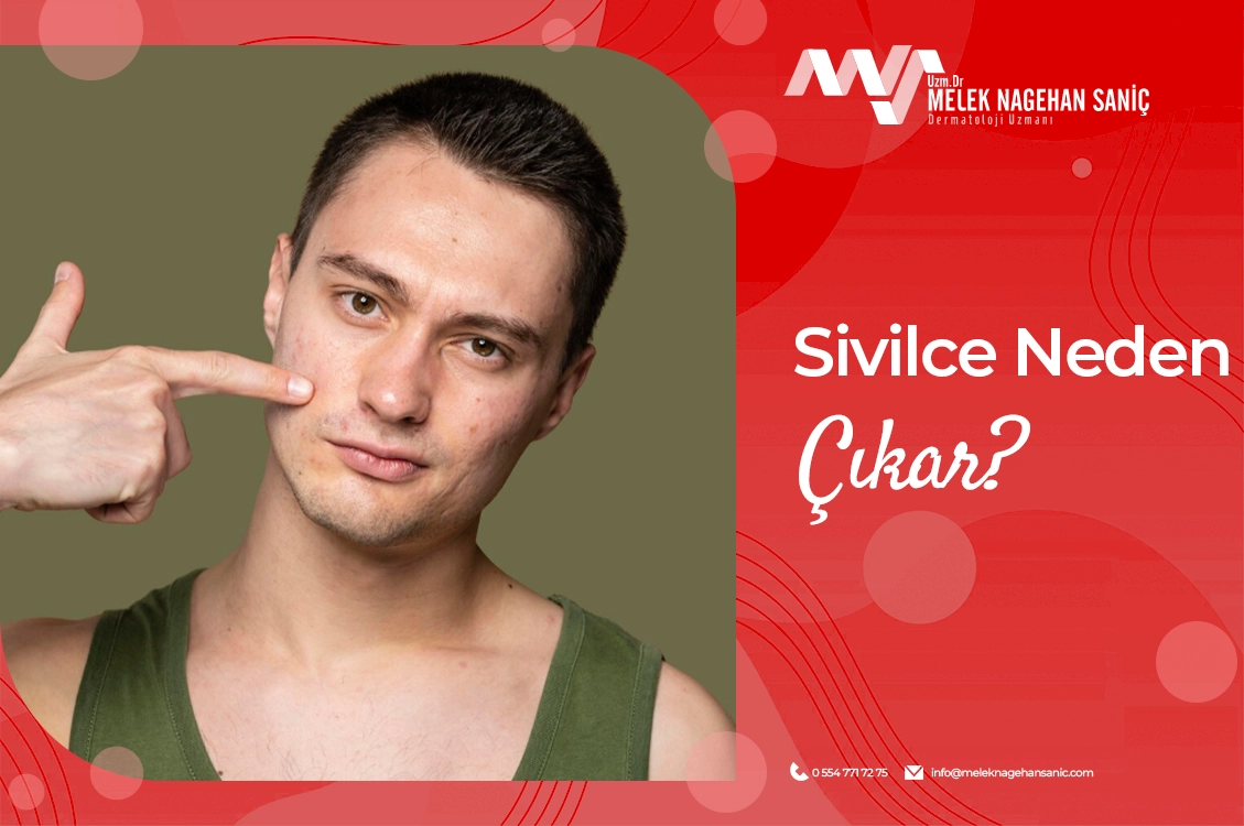 Sivilce Neden Çıkar?