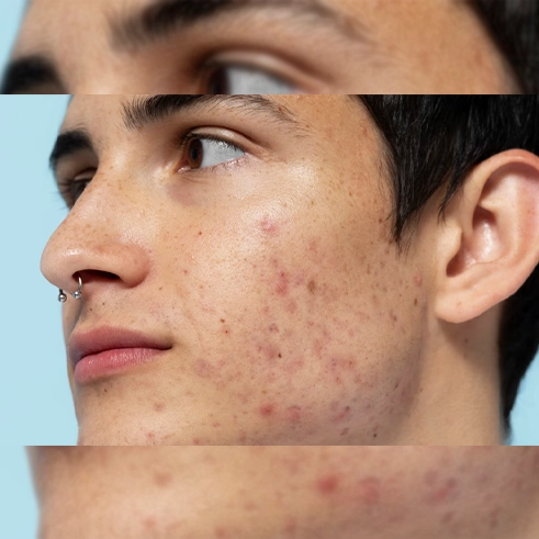 Sivilce Neden Çıkar?