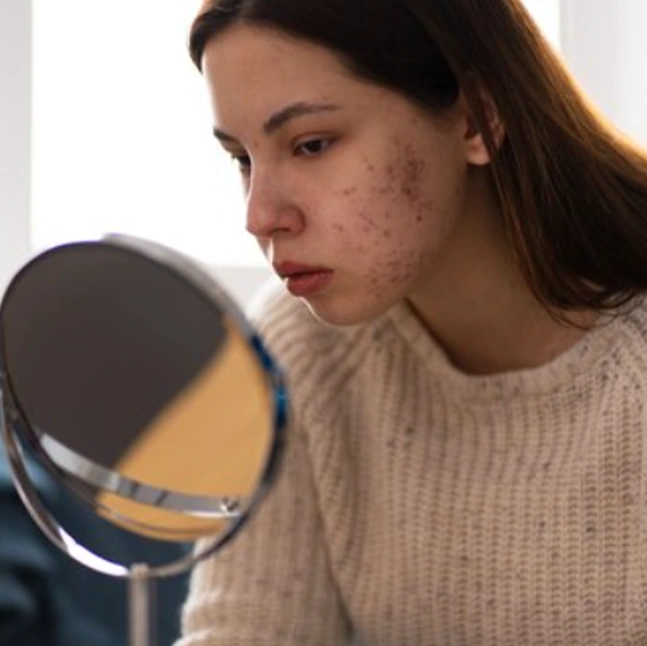 Sivilce Lazer Tedavisi Fiyat