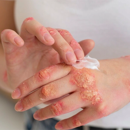 Ankara Egzama Tedavisi