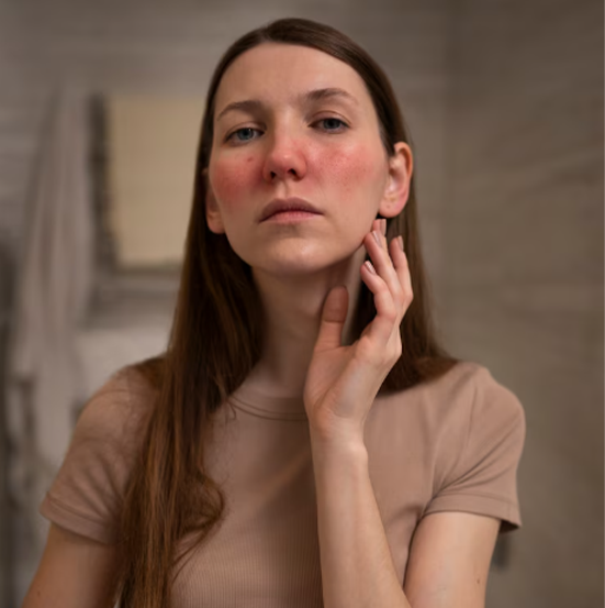 Cilt Tahrişi Nedir?