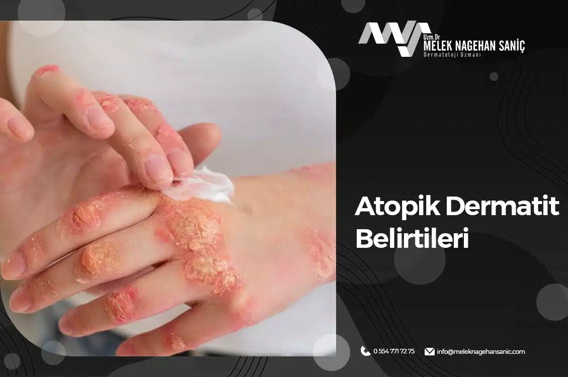 Atopik Dermatit Belirtileri - Atopik Dermatit Belirtileri Nelerdir?