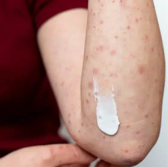 Cilt Kanseri Evreleri