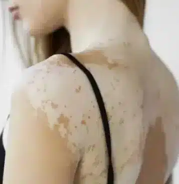 Ankara Dermatolog