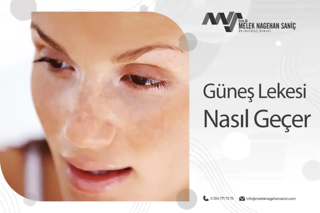 Güneş lekesi nasıl geçer