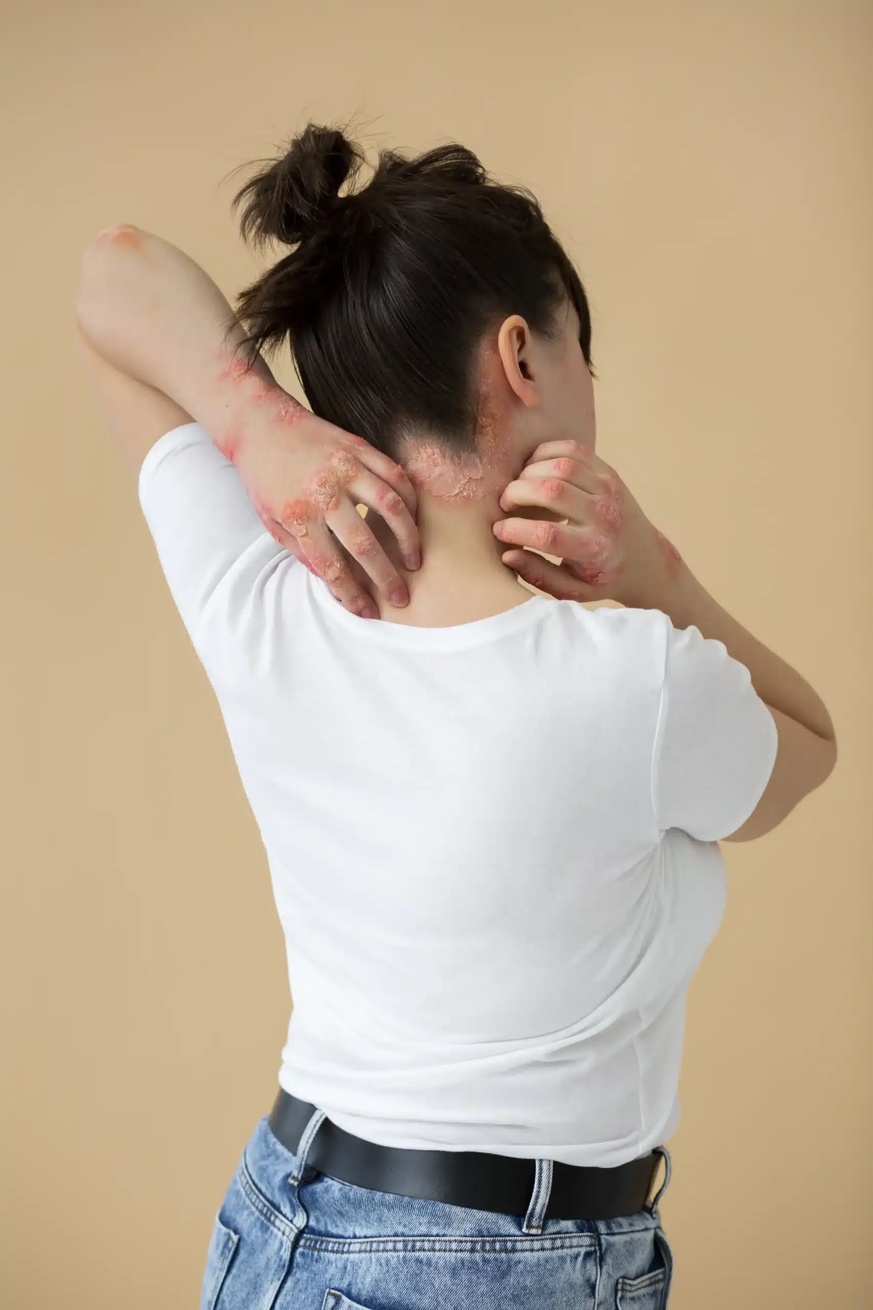 Seboreik Dermatit Nedir?