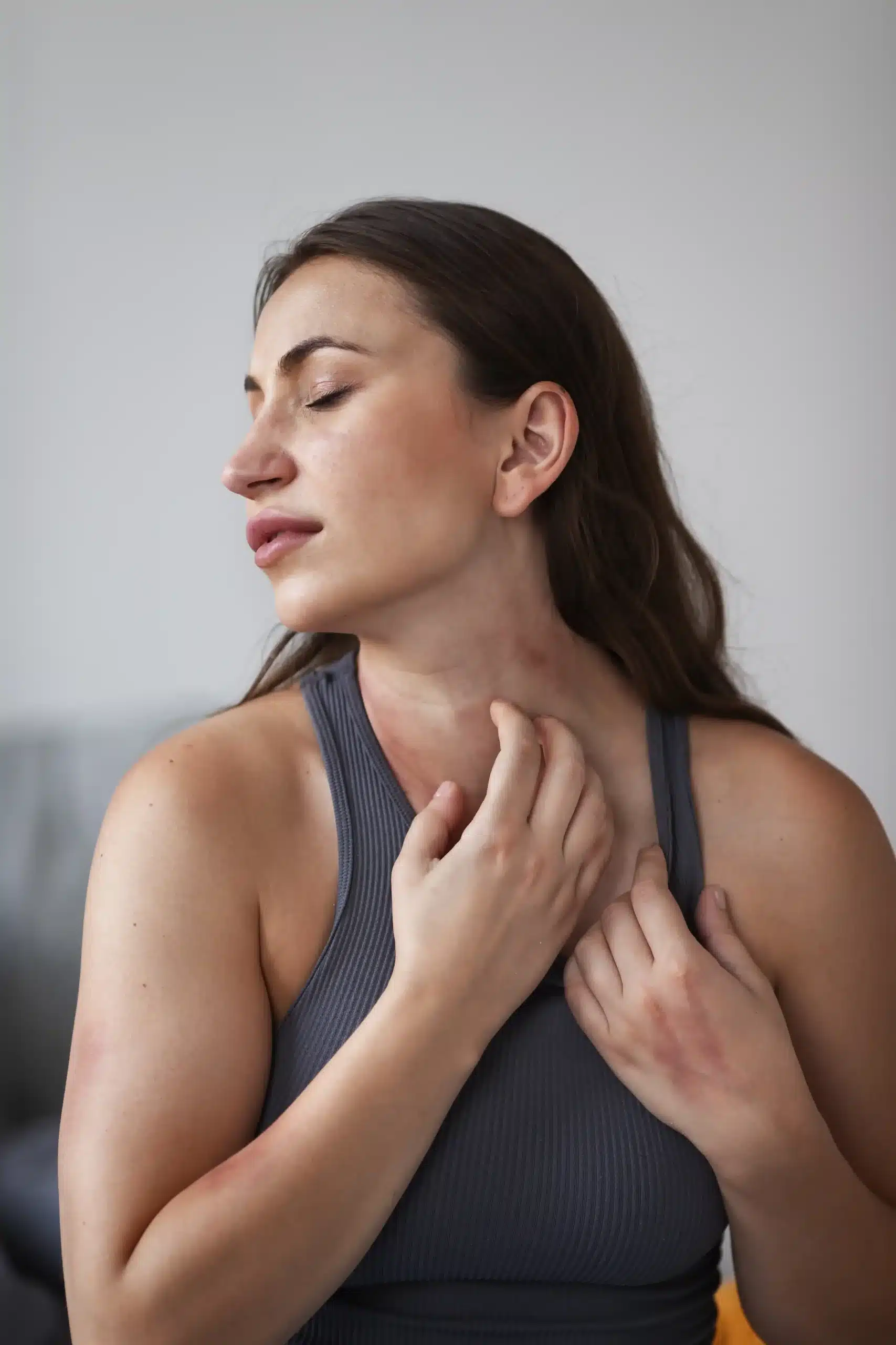 Seboreik Dermatit Nedir?