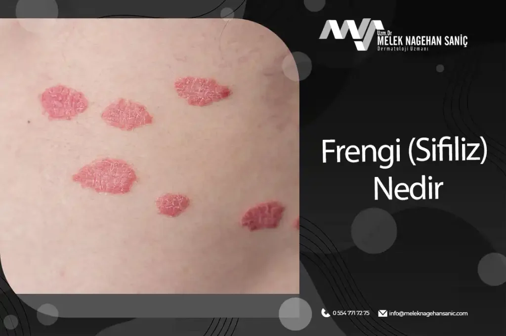 Frengi (sifiliz) nedir