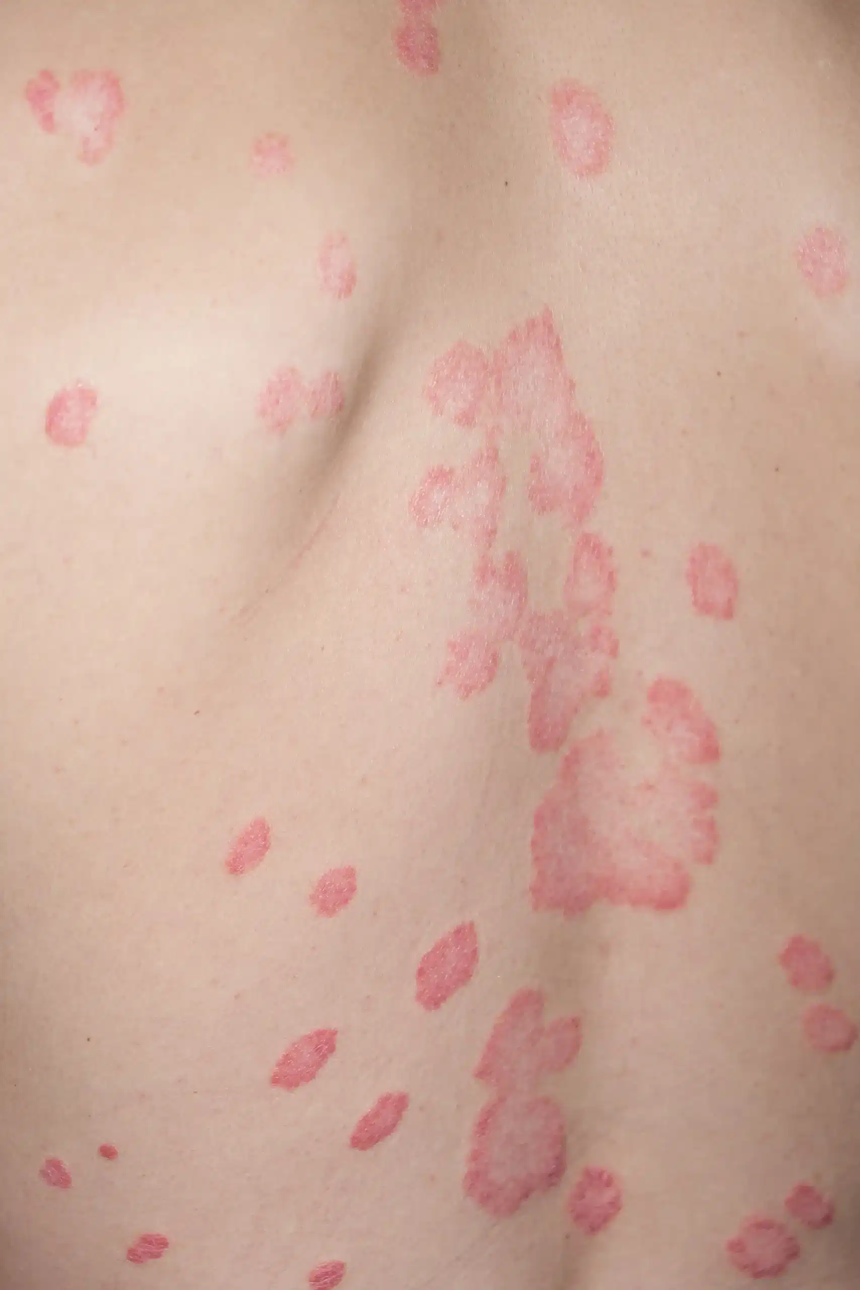 Frengi (sifiliz) nedir