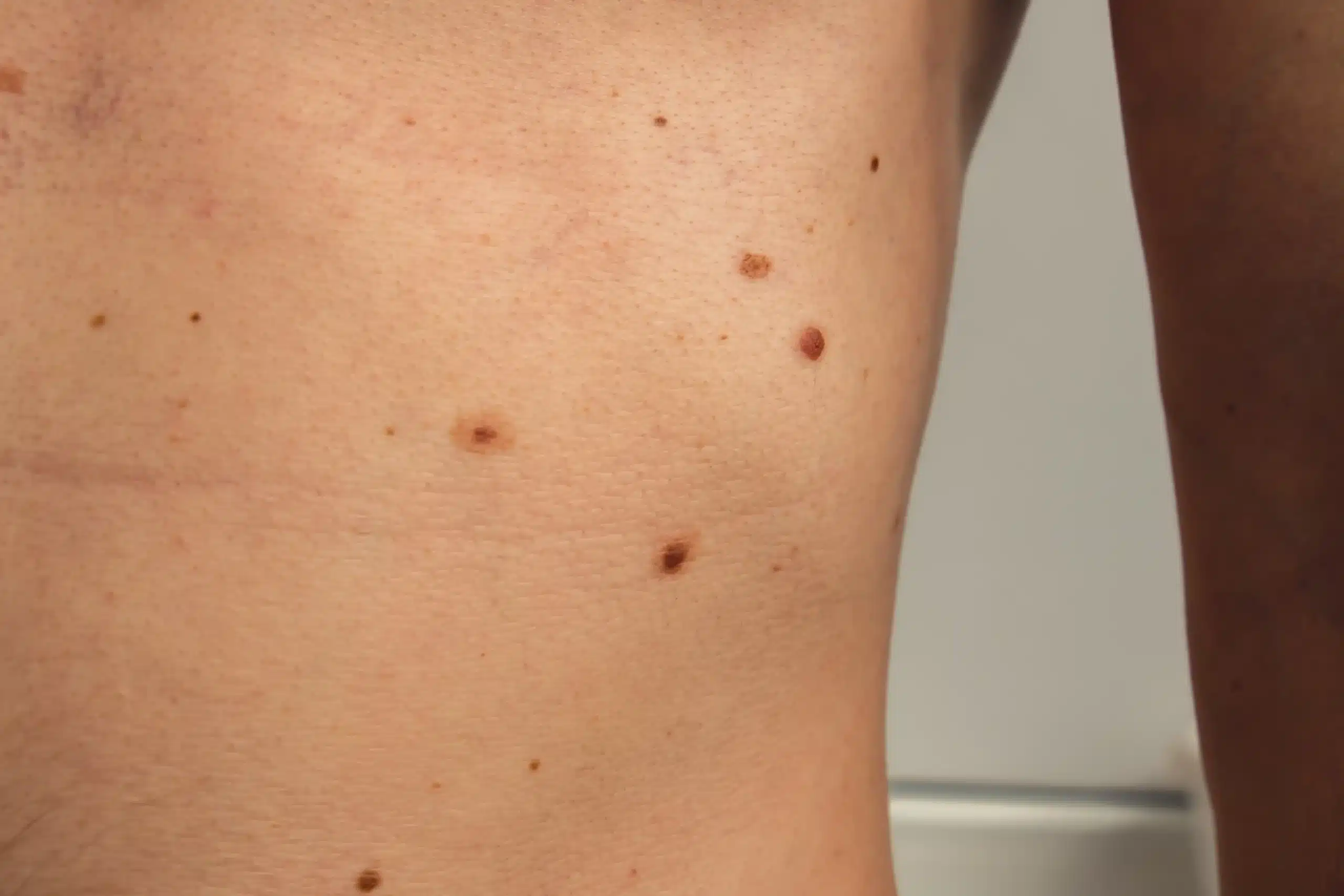 Frengi (sifiliz) nedir