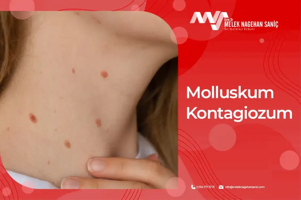 Molluskum Kontagiozum