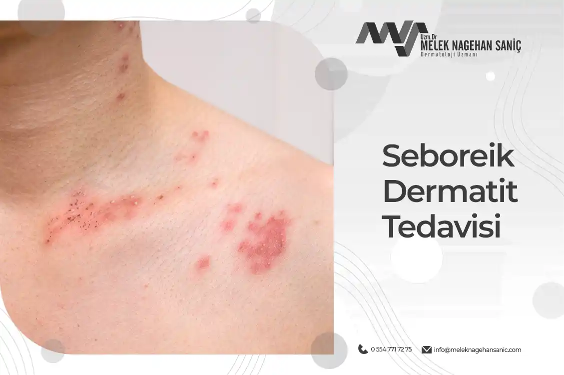 Seboreik Dermatit Tedavisi - Seboreik Dermatit Nedir? - Nagehan Saniç