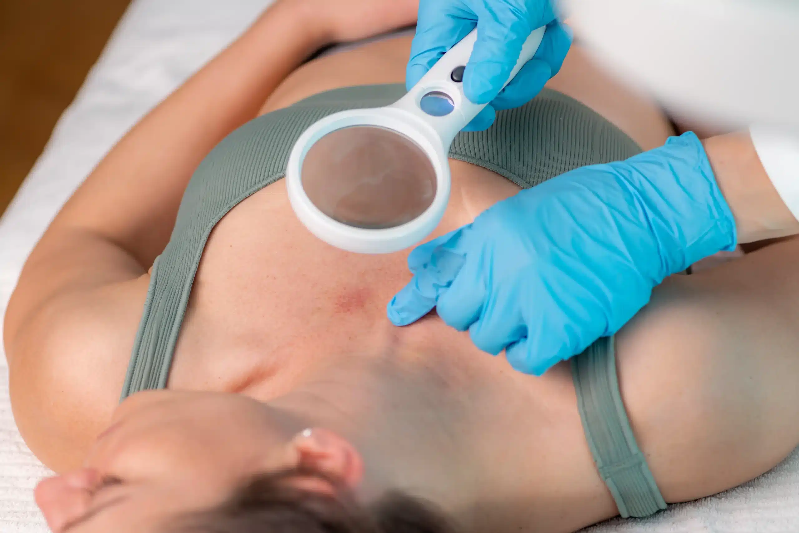 Seboreik Dermatit Tedavisi