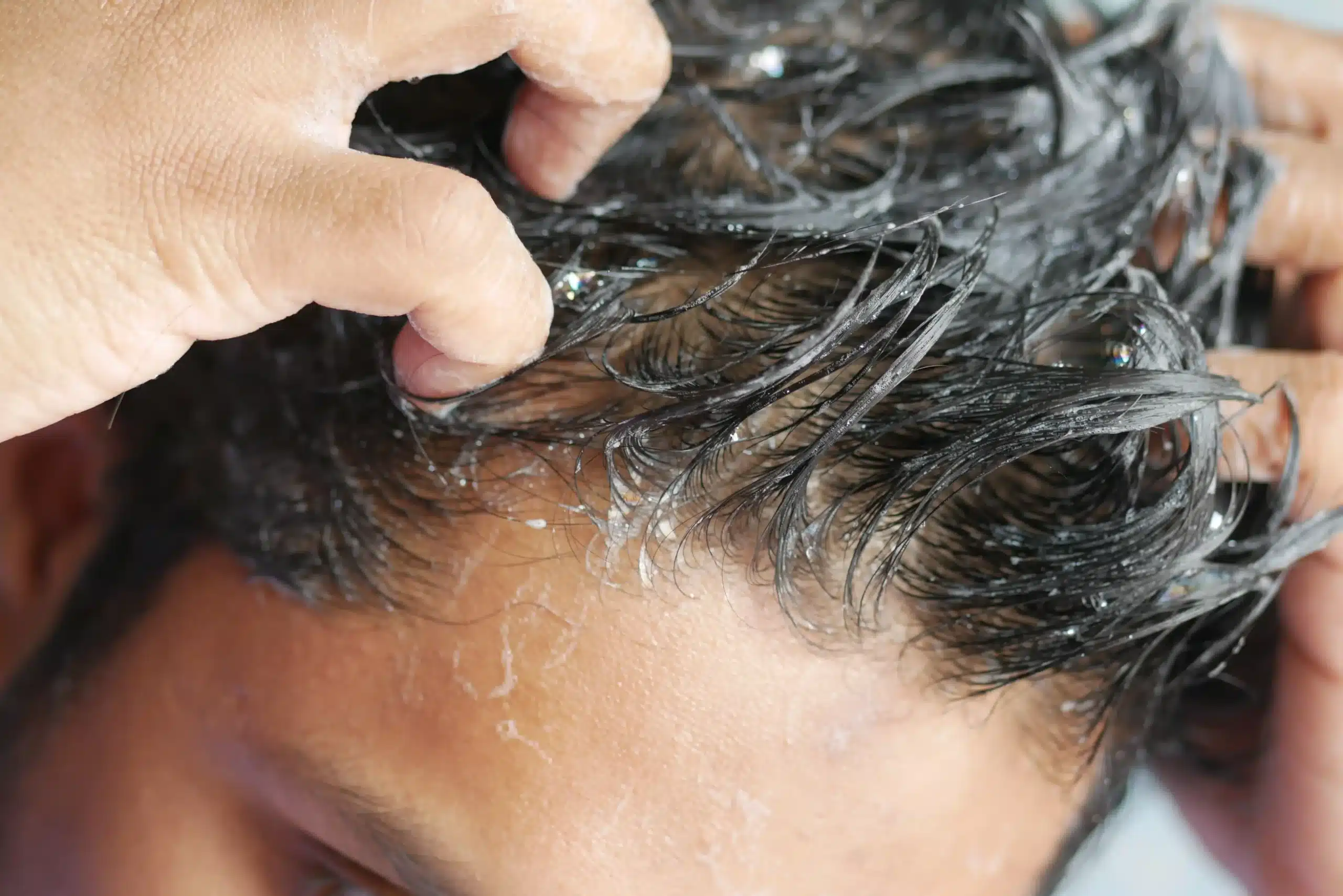 Saçkıran Tedavisi (Alopesi Areata Tedavisi)