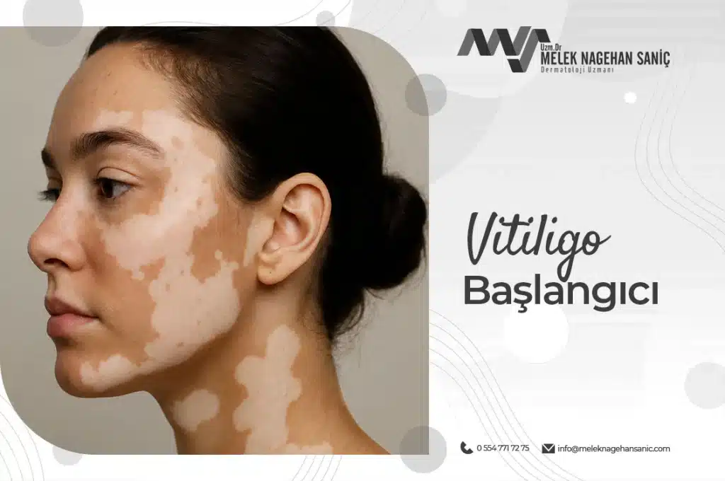 Vitiligo Başlangıcı