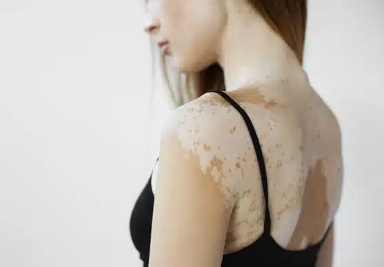 Vitiligo Başlangıcı